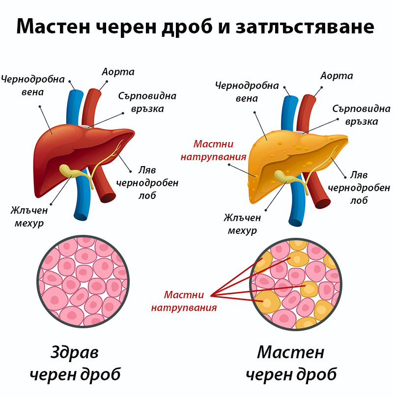 Мастен черен дроб и затлъстяване като причина за рак на черния дроб