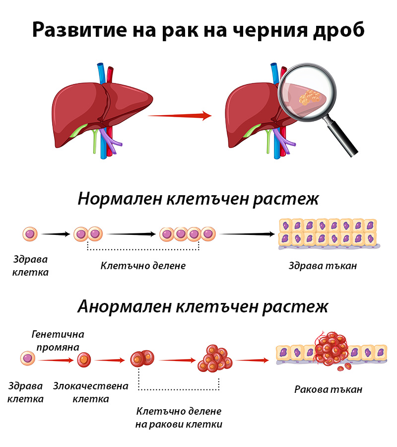 Развитие на рак на черния дроб