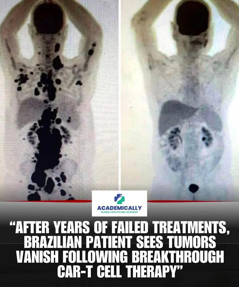 ПЕТ скенер на човек преди и след прилагане на CAR-T терапия