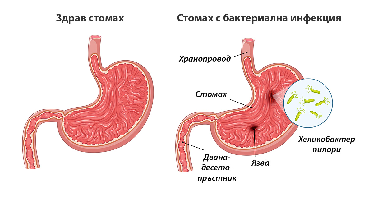 Ползи от лъвска грива (херициум) при бактериална инфекция